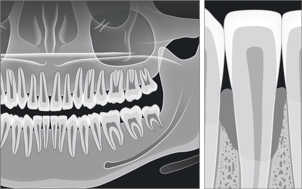 Radiographic Findings