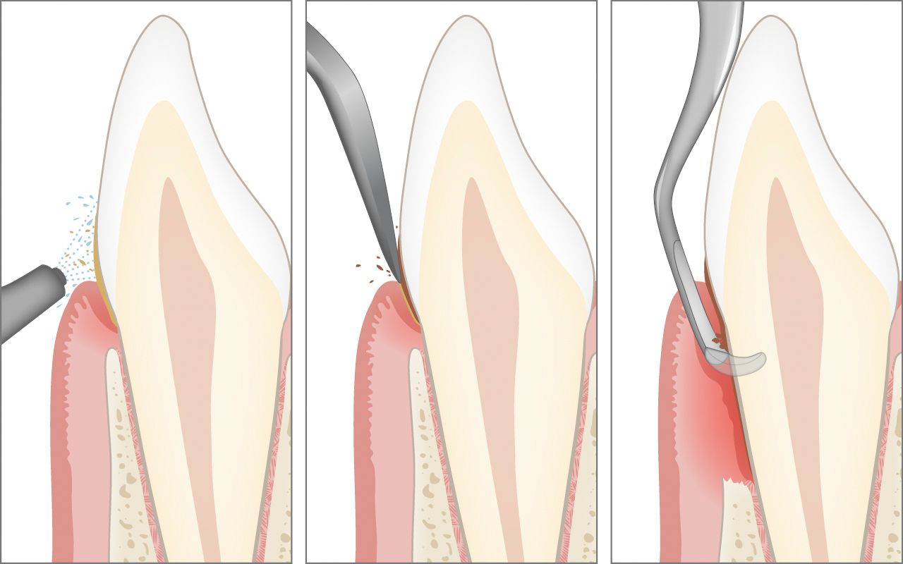 Professional Dental Cleaning