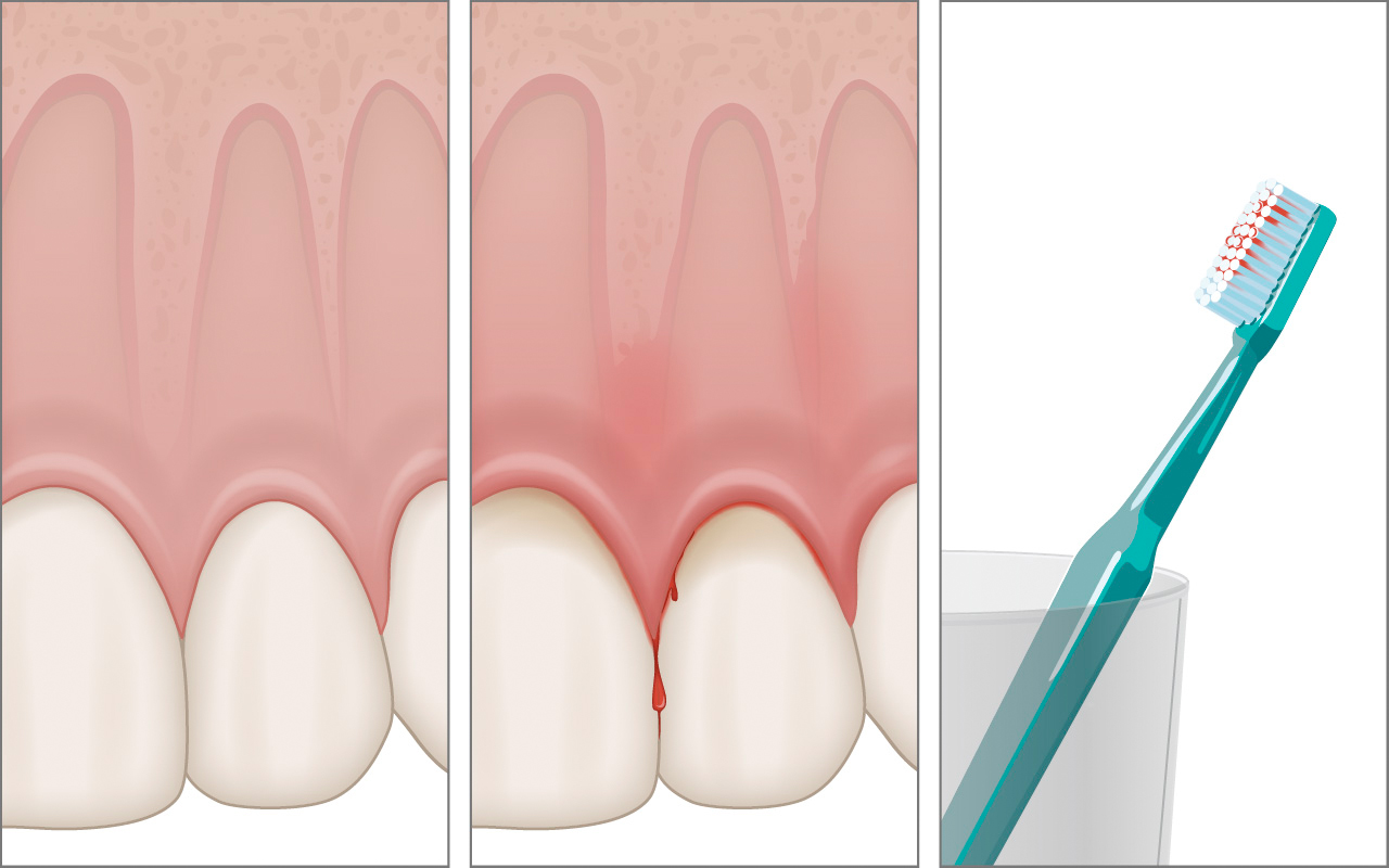 What is Gingivitis and how common is it?