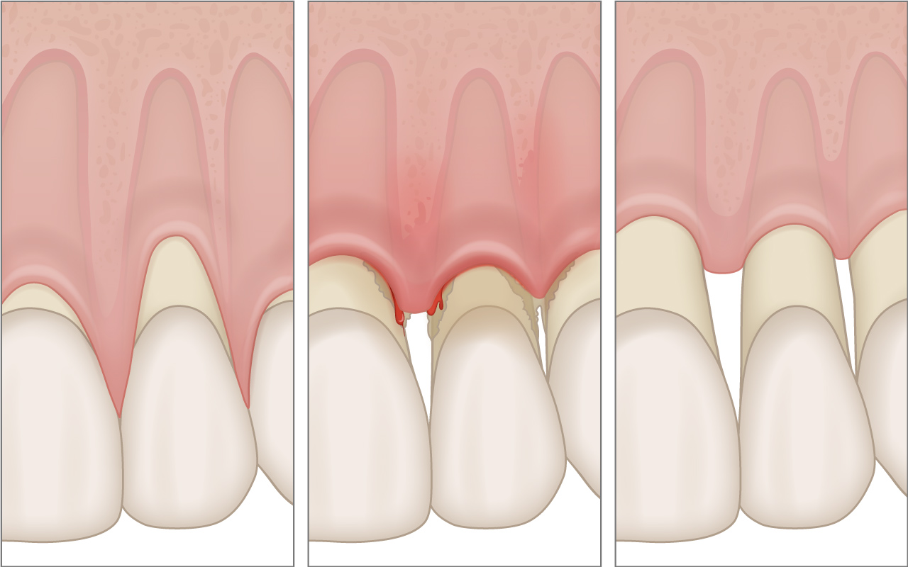 Attention: Gum recession is not just gum recession